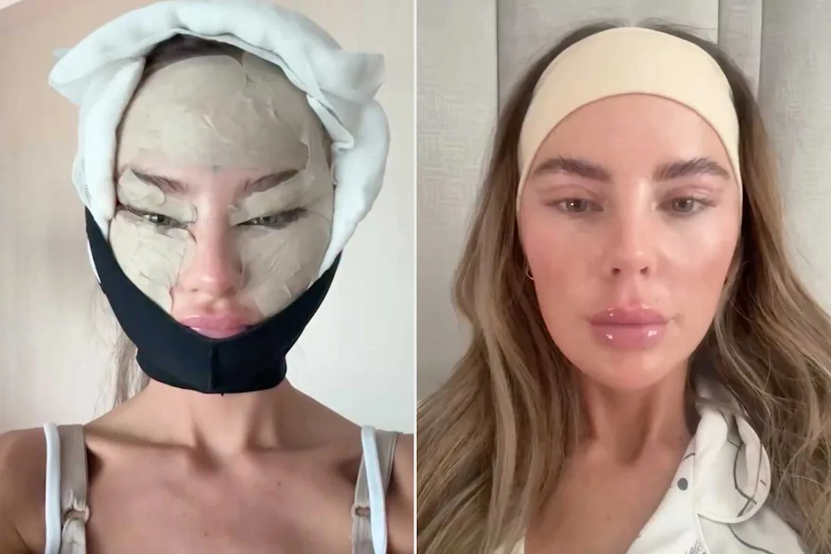 Woman Underwent Plastic Surgery in Turkey, Then Shared the Unfiltered Photos from Her 'No Pain' 15-Day Recovery