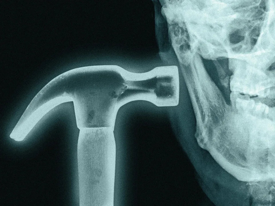 X-ray showing a skull profile with a hammer positioned against the jaw, creating a surreal, artistic impression