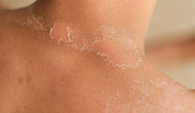 Portugal orders the withdrawal of burn relief product