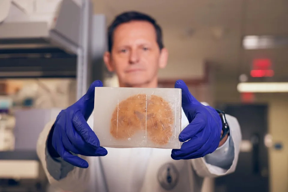 Neuropathologist Dr. Gabor Kovacs, from the University of Toronto's Krembil Brain Institute, holds up a donated human brain encased in paraffin wax.