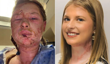 Student, 18, Who Suffered Severe Burns from a House Fire Recovers After World-First Experimental Treatment