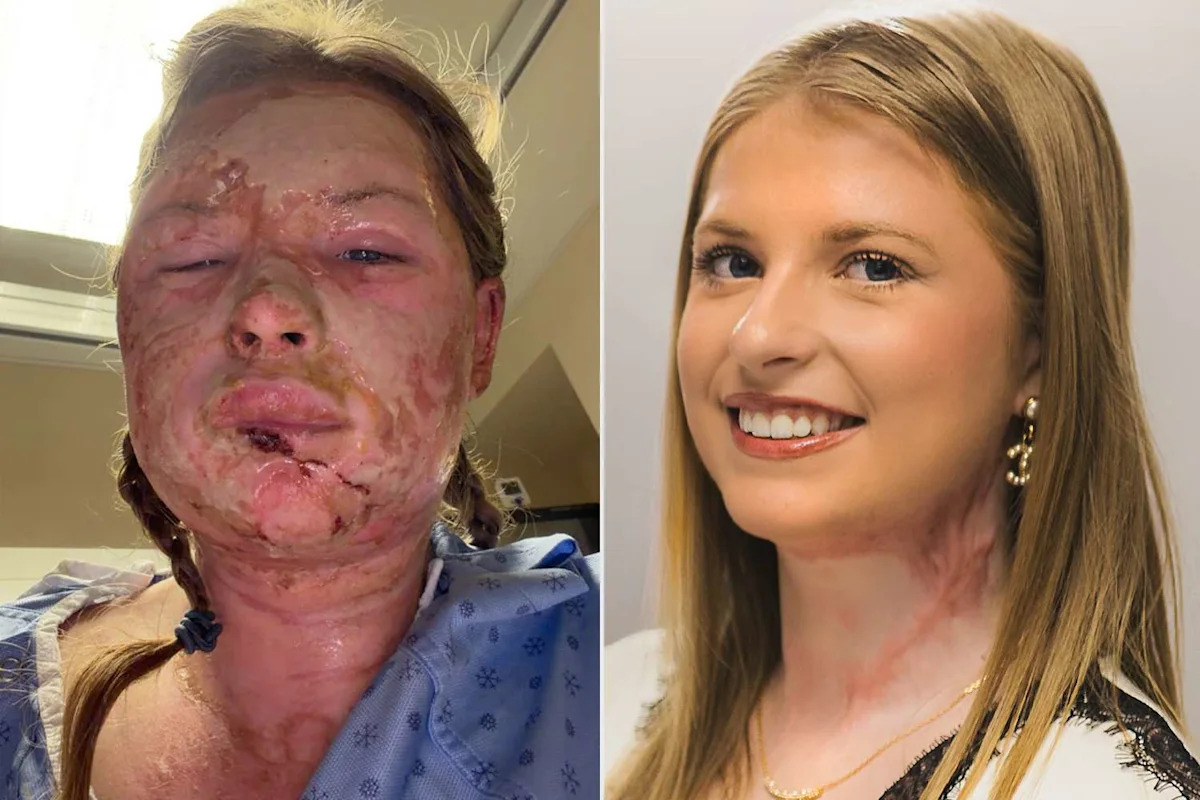 Student, 18, Who Suffered Severe Burns from a House Fire Recovers After World-First Experimental Treatment