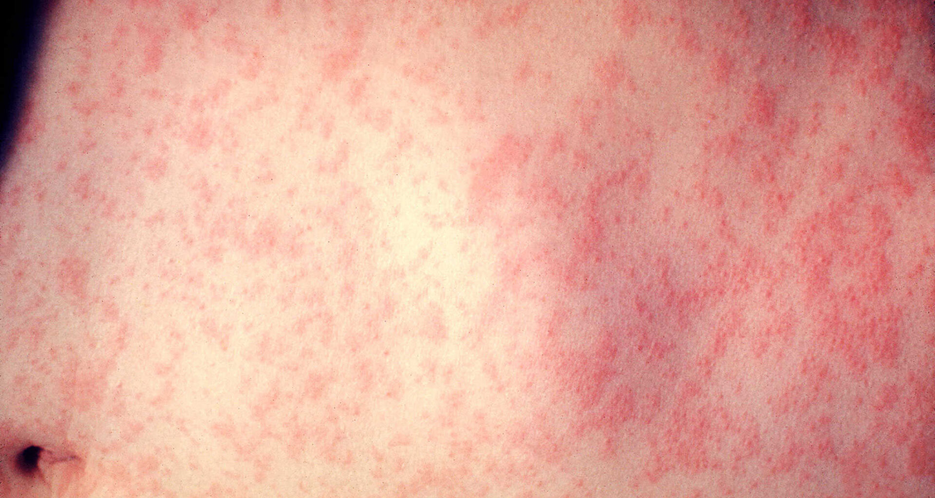 measles pearson airport mississauga toronto ontario