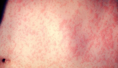 measles pearson airport mississauga toronto ontario