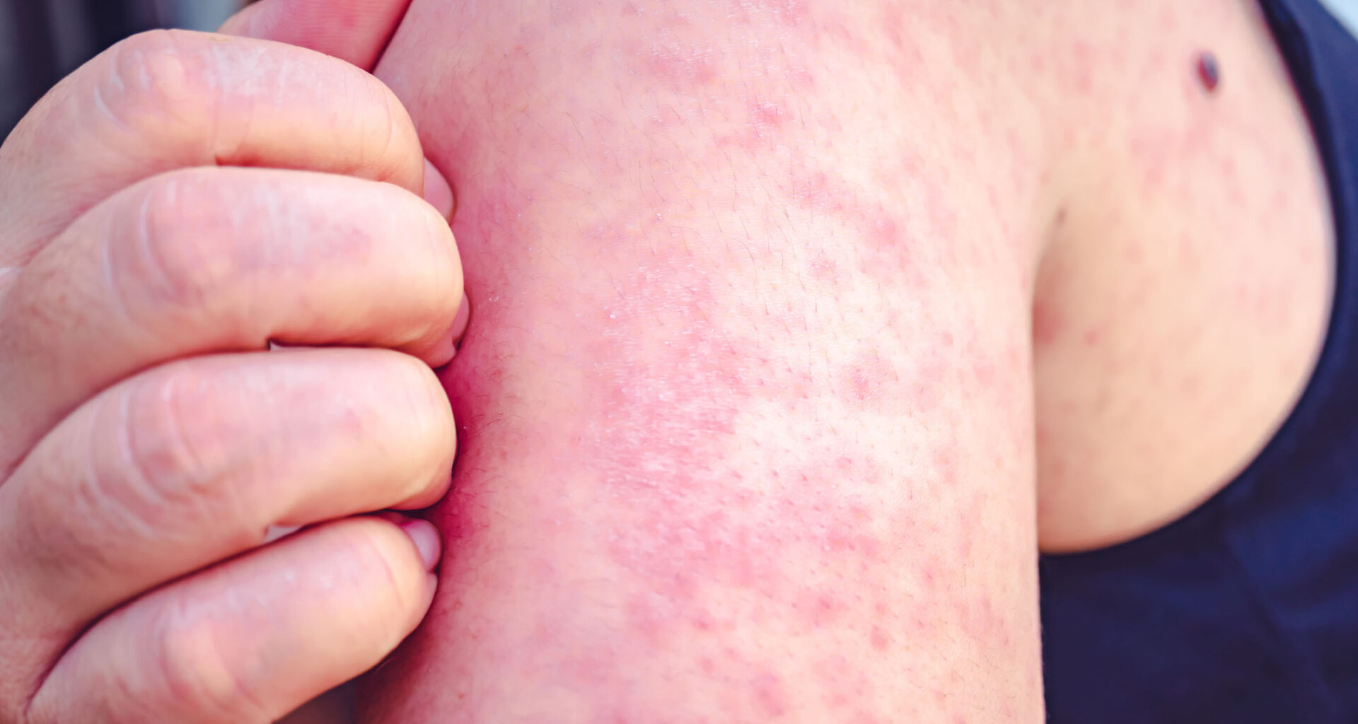 Measles exposure alert issued for SW Calgary medical clinic