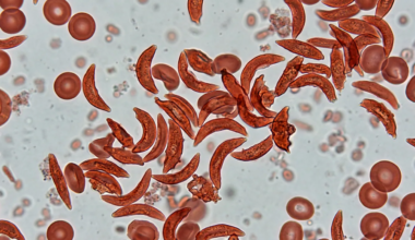 India's Sickle Cell Anemia Burden: Why Certain Regions And Communities Are More Affected