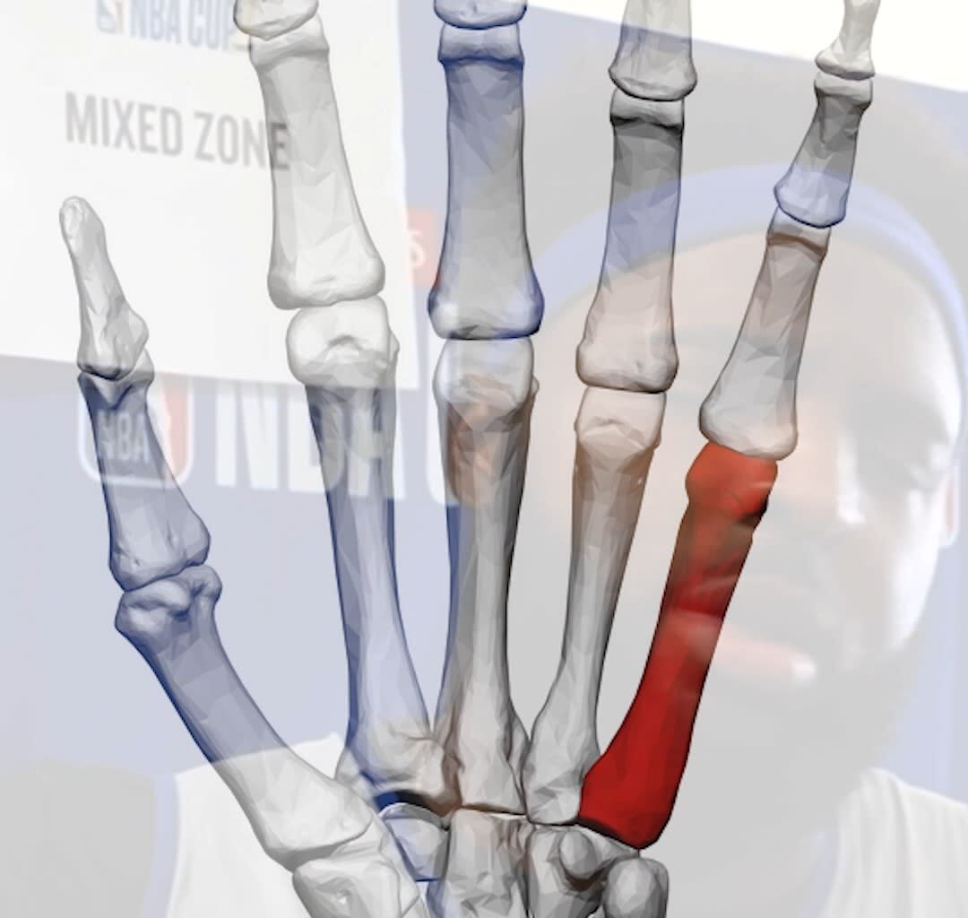 What is a boxer's fracture?