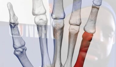 What is a boxer's fracture?