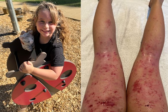 Ally North has not been able to secure compassionate access to dupilumab.