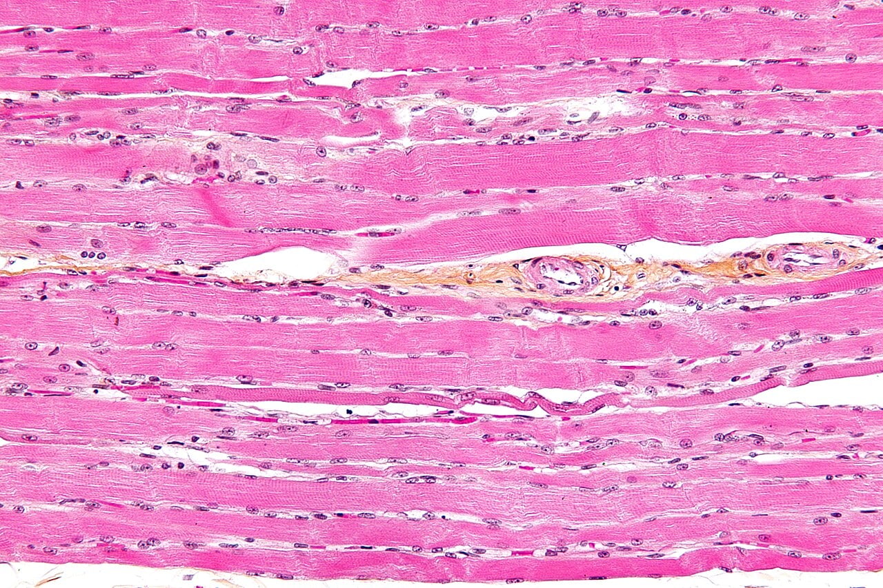 Microscopic view of striated skeletal muscle fibre, showing the banded pattern disrupted during muscle wastage (Credit : Nephron)