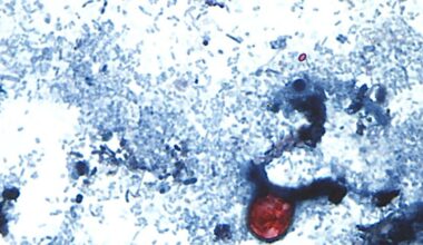 Cyclospora outbreaks: Parasite not in Canada, PHAC says