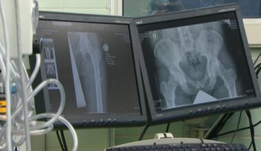Islanders are waiting longer for hip, knee replacements than other Canadians, study says