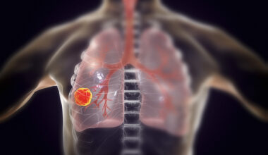 Lung cancer, illustration
