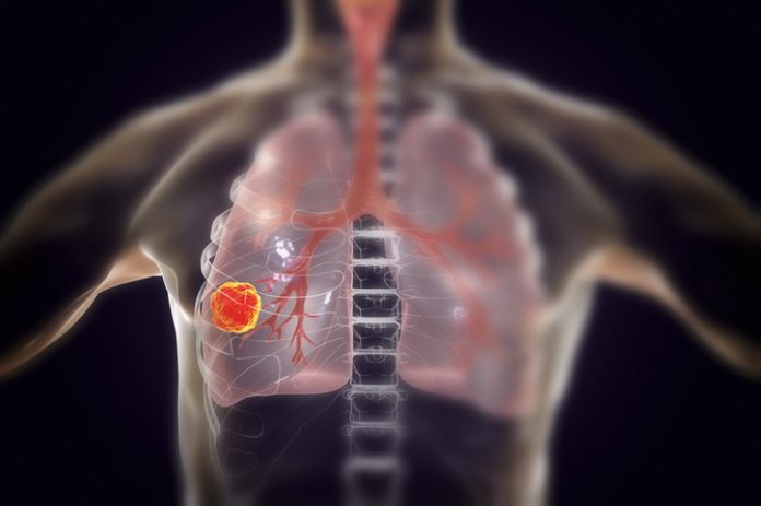 Lung cancer, illustration