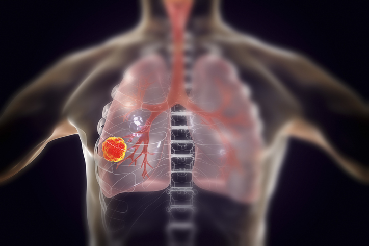 Lung cancer, illustration