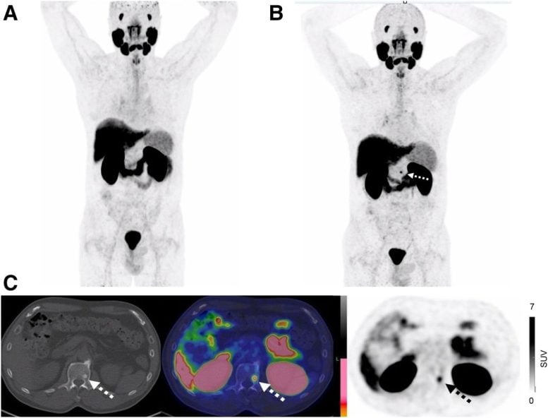 58 Year Old Man After Radical Prostatectomy for pT2a pN0 Prostate Cancer