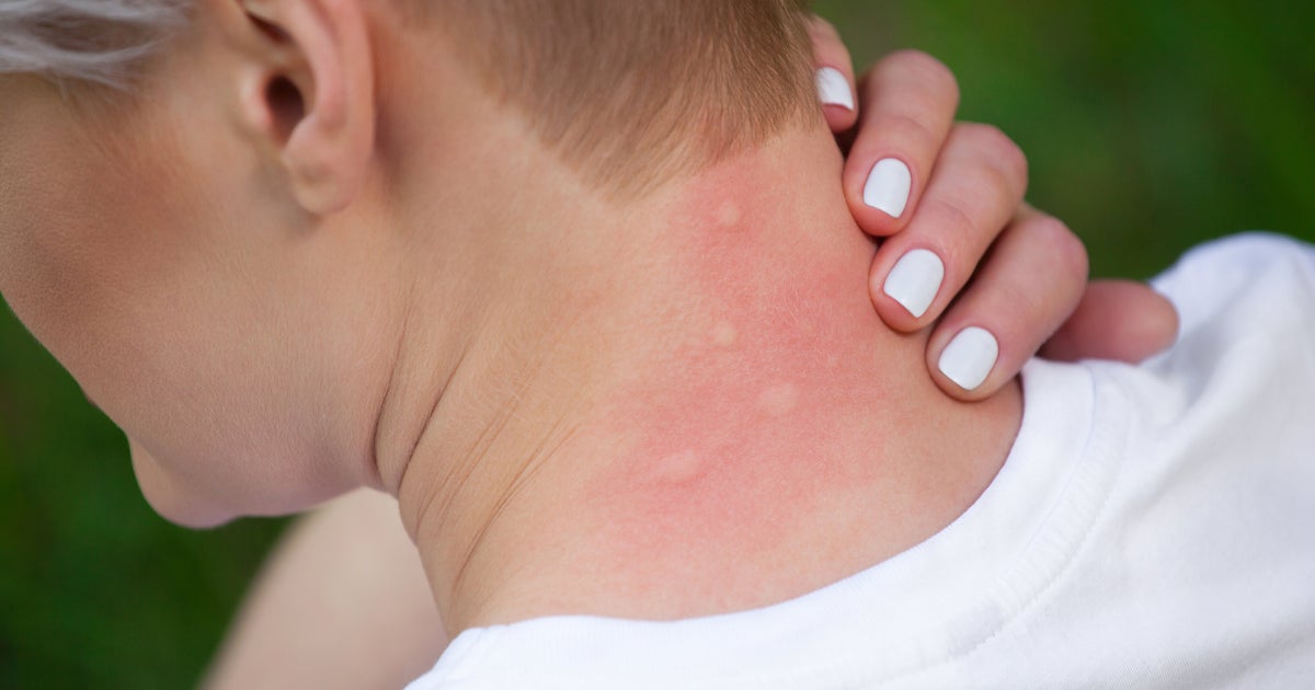 Why Do Mosquitoes Bite Some People More Than Others?