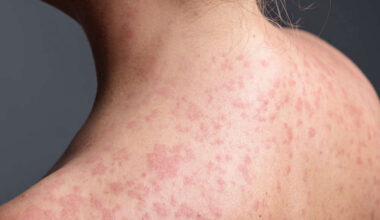 Confirmed Measles Case In Nanaimo