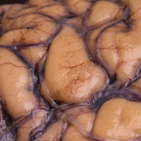 A donated brain for the Australian Sports Brain Bank.