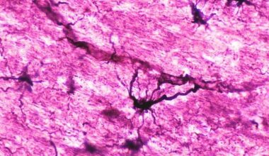 Two People With Severe Autoimmune Disease in Remission After Immune 'Reset' : ScienceAlert