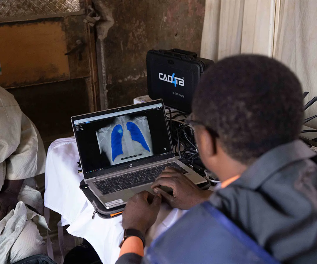 Unitaid and CHAI cut cost of AI screening software, unlocking affordable TB detection in communities without radiologists