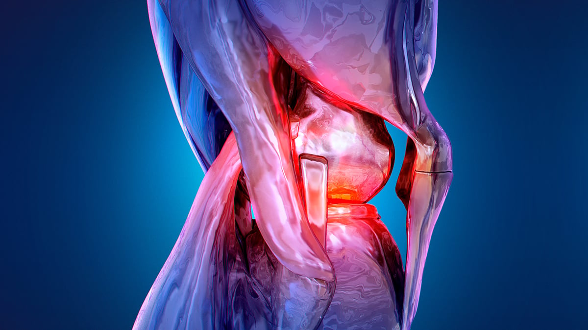 Non-Surgical Procedure Halves Knee Pain Over 12-Month Trial : ScienceAlert