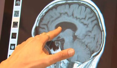 Up to 45% of dementia risk can be prevented, delayed: WHO - CTV News