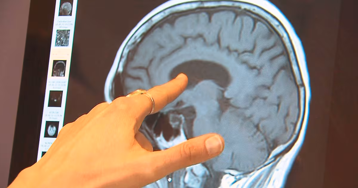 Up to 45% of dementia risk can be prevented, delayed: WHO - CTV News