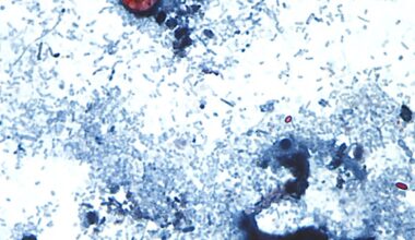 What Canadians need to know about cyclosporiasis, the gastrointestinal illness outbreak hitting the U.S.