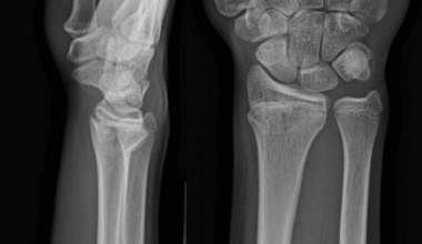 Pediatric Extensor Pollicis Longus Rupture After Distal Radius Fracture: A Case Report