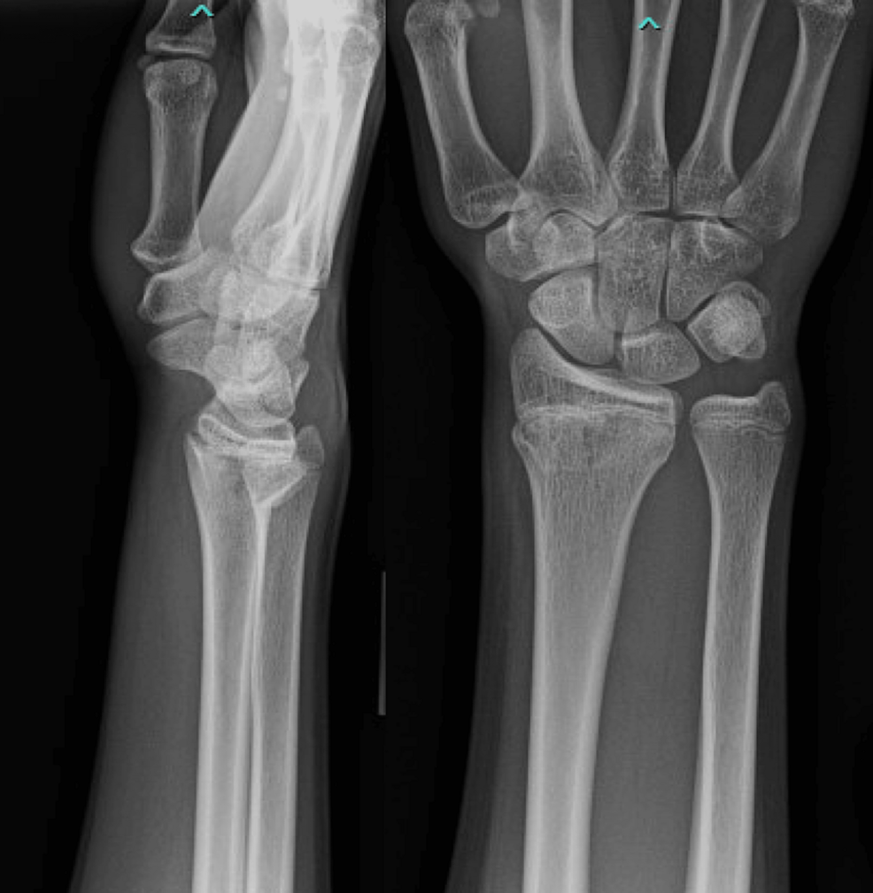 Pediatric Extensor Pollicis Longus Rupture After Distal Radius Fracture: A Case Report