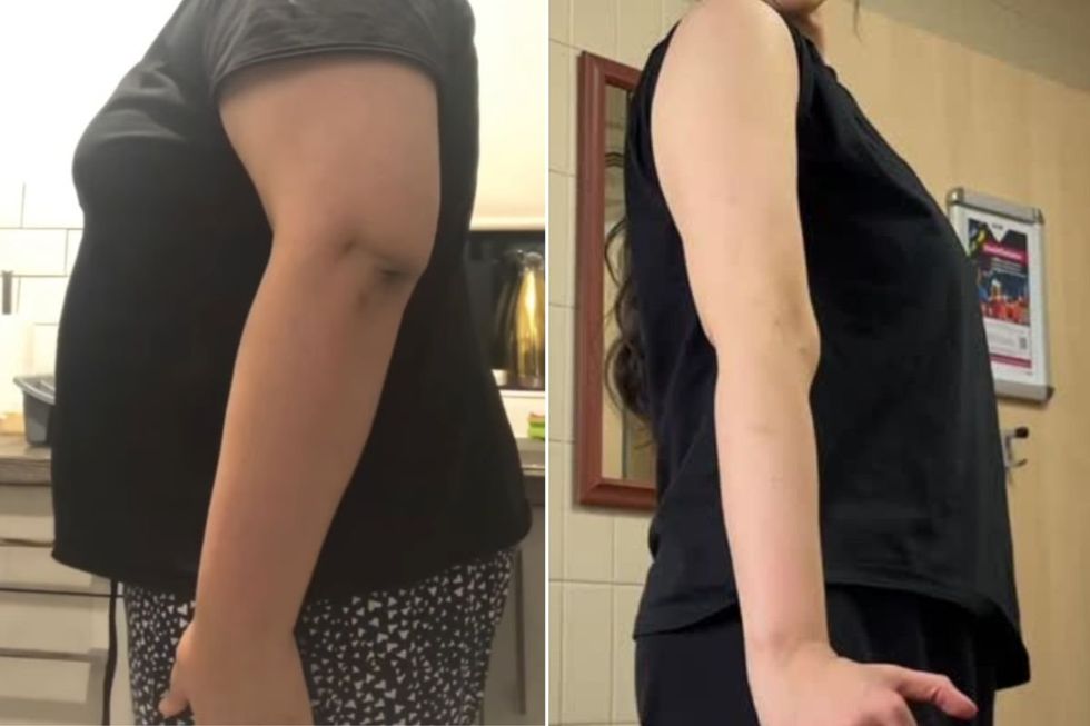 BEFORE AND AFTER ARMS