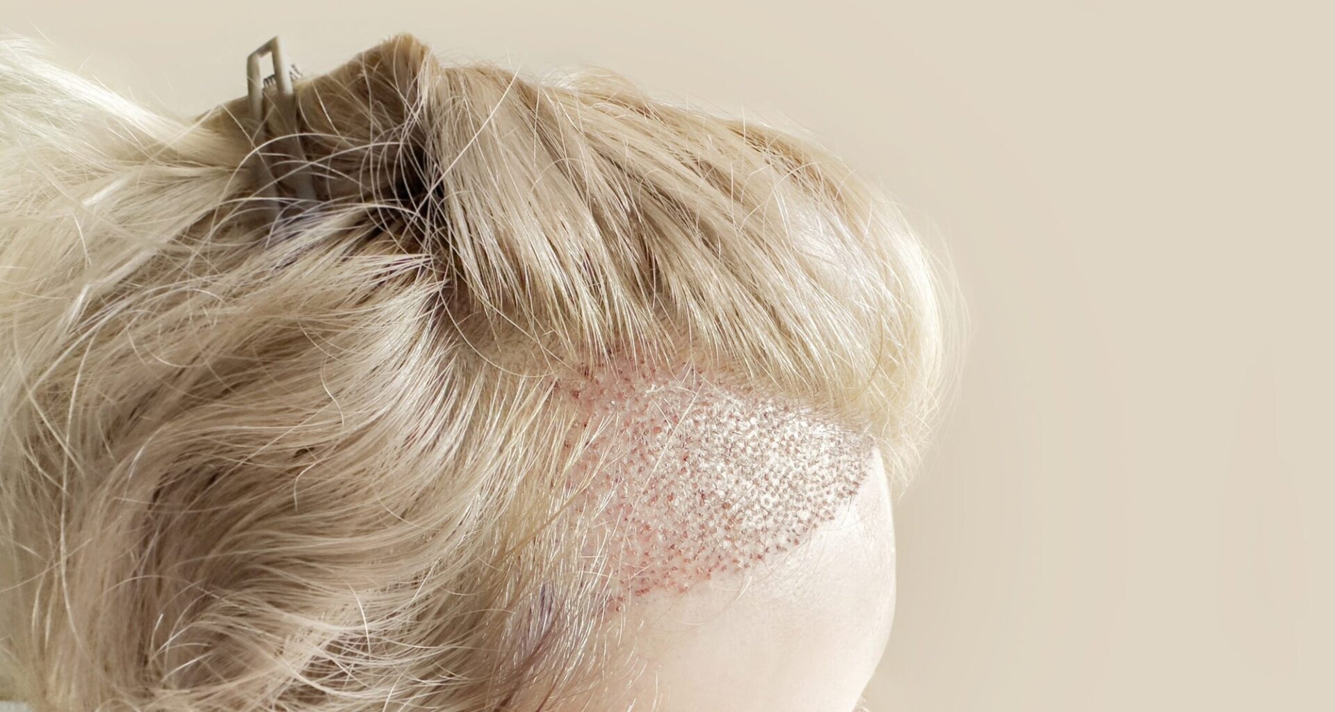 Scientists discover how natural hair patterns form without a blueprint