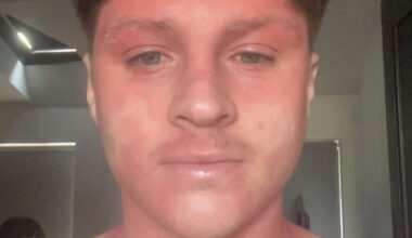Skin cream withdrawal pain 'like being electrocuted' left footballer stuck in bed
