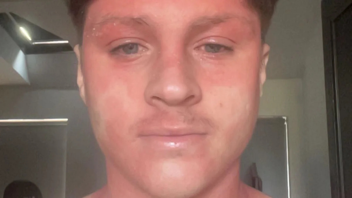 Skin cream withdrawal pain 'like being electrocuted' left footballer stuck in bed