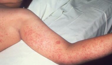 Toronto Public Health lists recent measles exposures – CP24