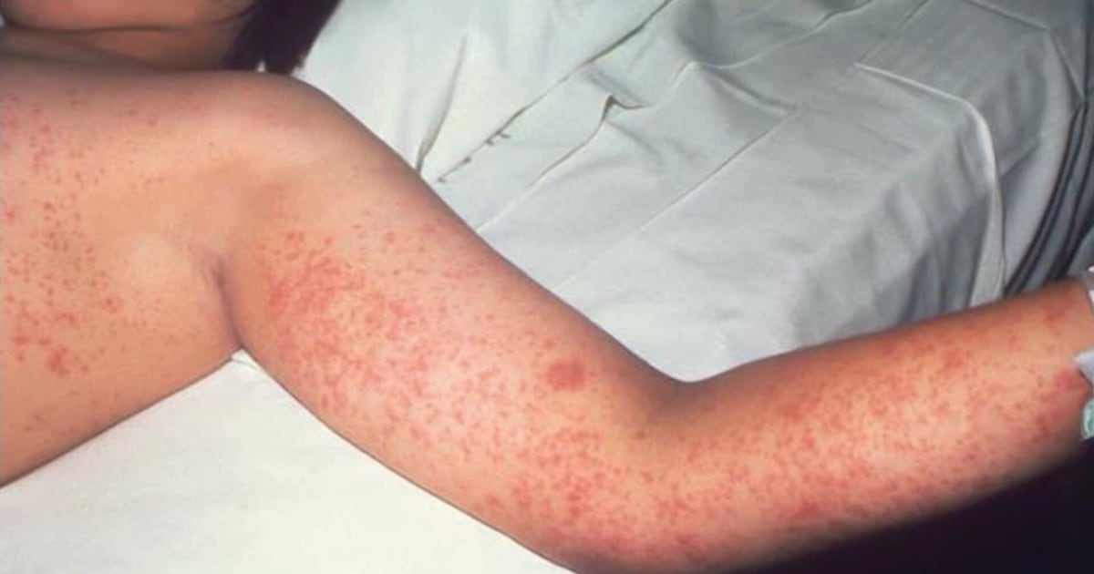 Toronto Public Health lists recent measles exposures – CP24