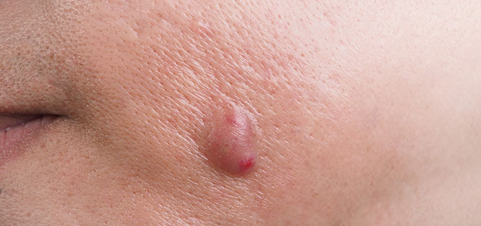 A close-up of a large pimple on skin, a medical symptom doctors wish people would stop ignoring.