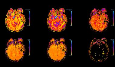 Drug Taken for Common Condition May Be Slowing Alzheimer’s Decline
