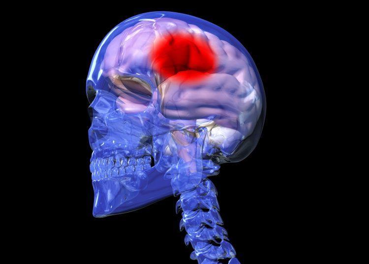 New stroke drug reduces brain damage by 60 percent in preclinical study | News