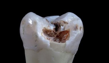 A 10-Second Treatment Can Stop Tooth Decay in Kids Without Drilling : ScienceAlert