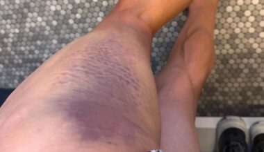 "Not the best scenario, but its life,eh." Primoz Roglic hit by car in training