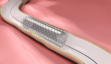 Trial shows antiplatelet therapy needs personalization after stent implantation