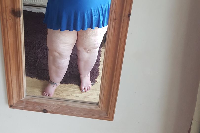 Abigail started gaining weight in her teens