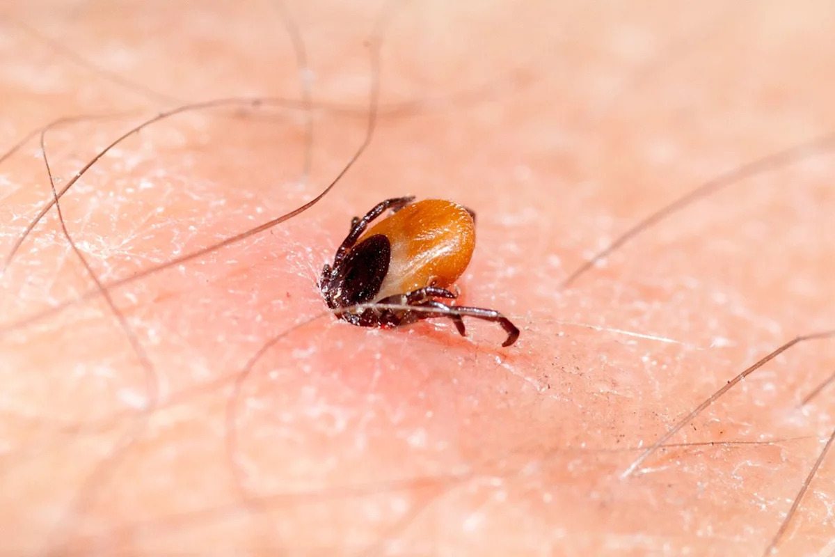Tick Bite on Vacation Left Mom in a Coma for 42 Days and Suffering from Seizures and Memory Loss
