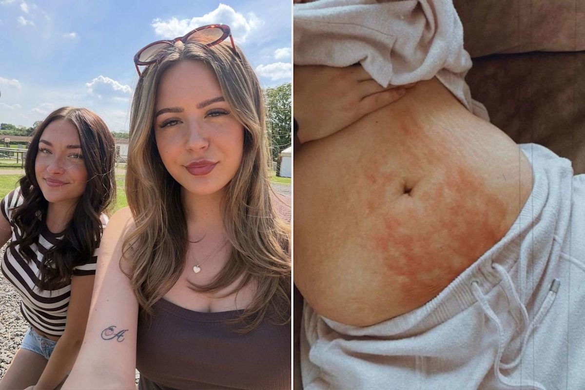 Sisters Both Get Diagnosed with Endometriosis After Doctors Dismissed Their Debilitating Pain as ‘Just Bad Periods’ for Years