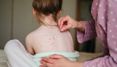 Florida Seeks to Remove 4 Vaccines, Including Chickenpox, from School Requirements