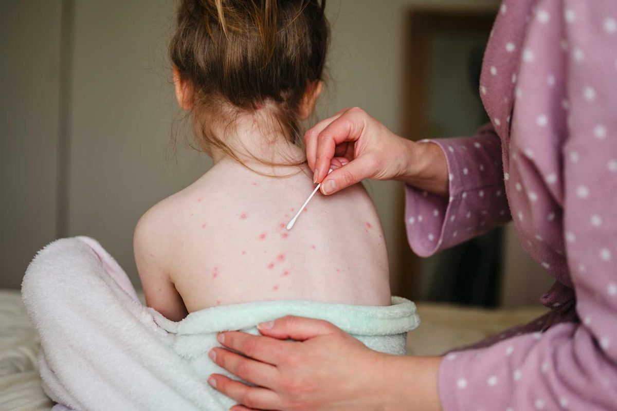 Florida Seeks to Remove 4 Vaccines, Including Chickenpox, from School Requirements