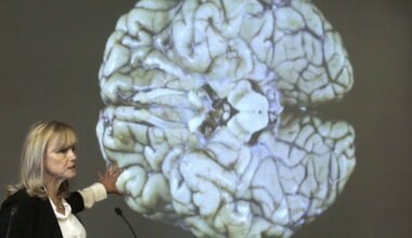 At least 1 in 4 NFL players who died in recent years had CTE, study finds