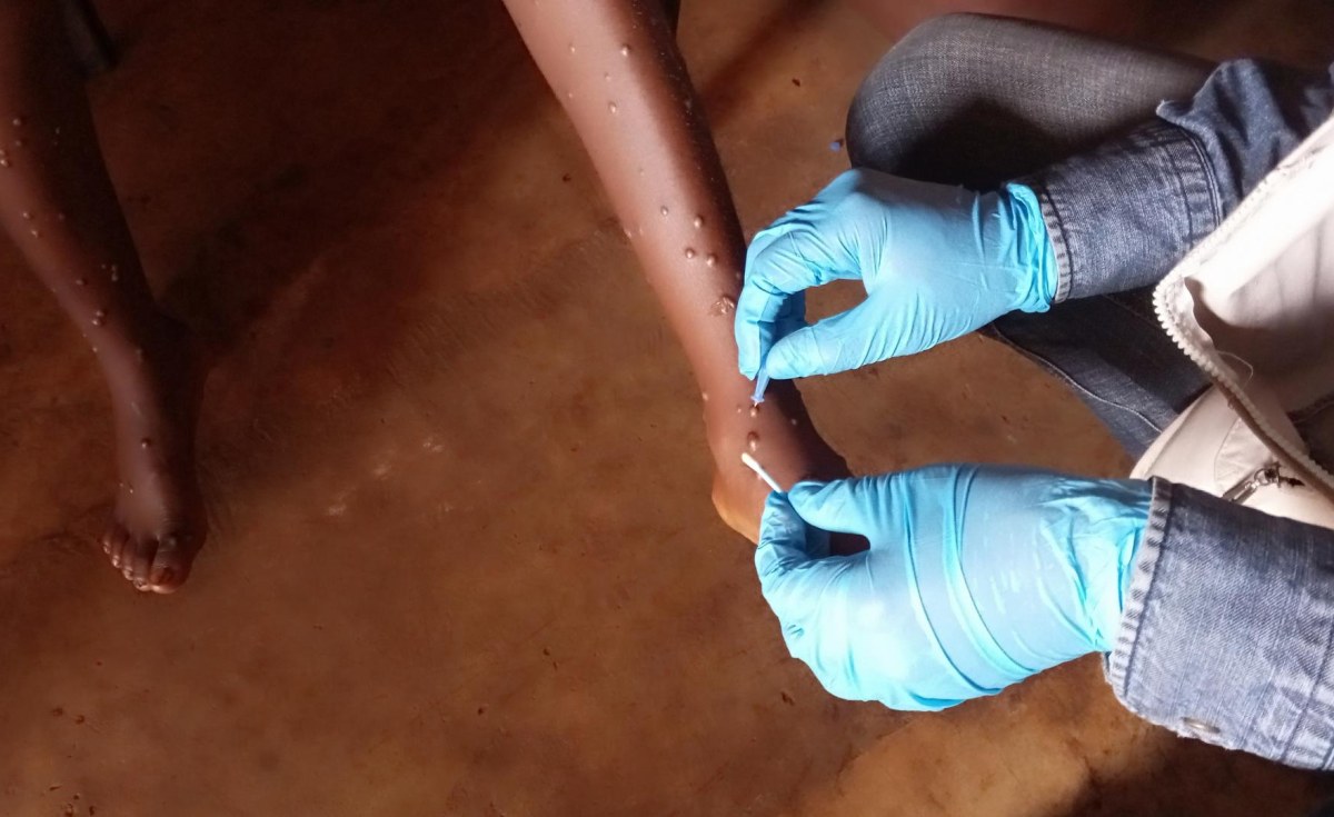 Africa: 11 African Countries Record 1,153 Mpox Cases in Six Weeks